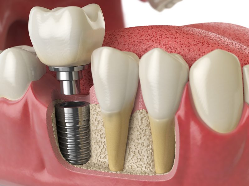 dental_implants_orlando