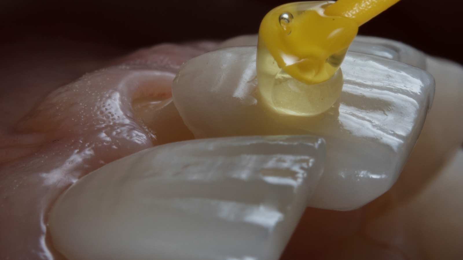 essential dos and don’ts for caring for your porcelain veneers