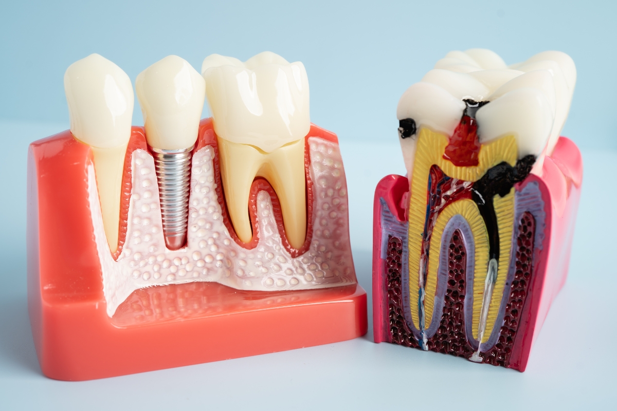 root canal in Orlando