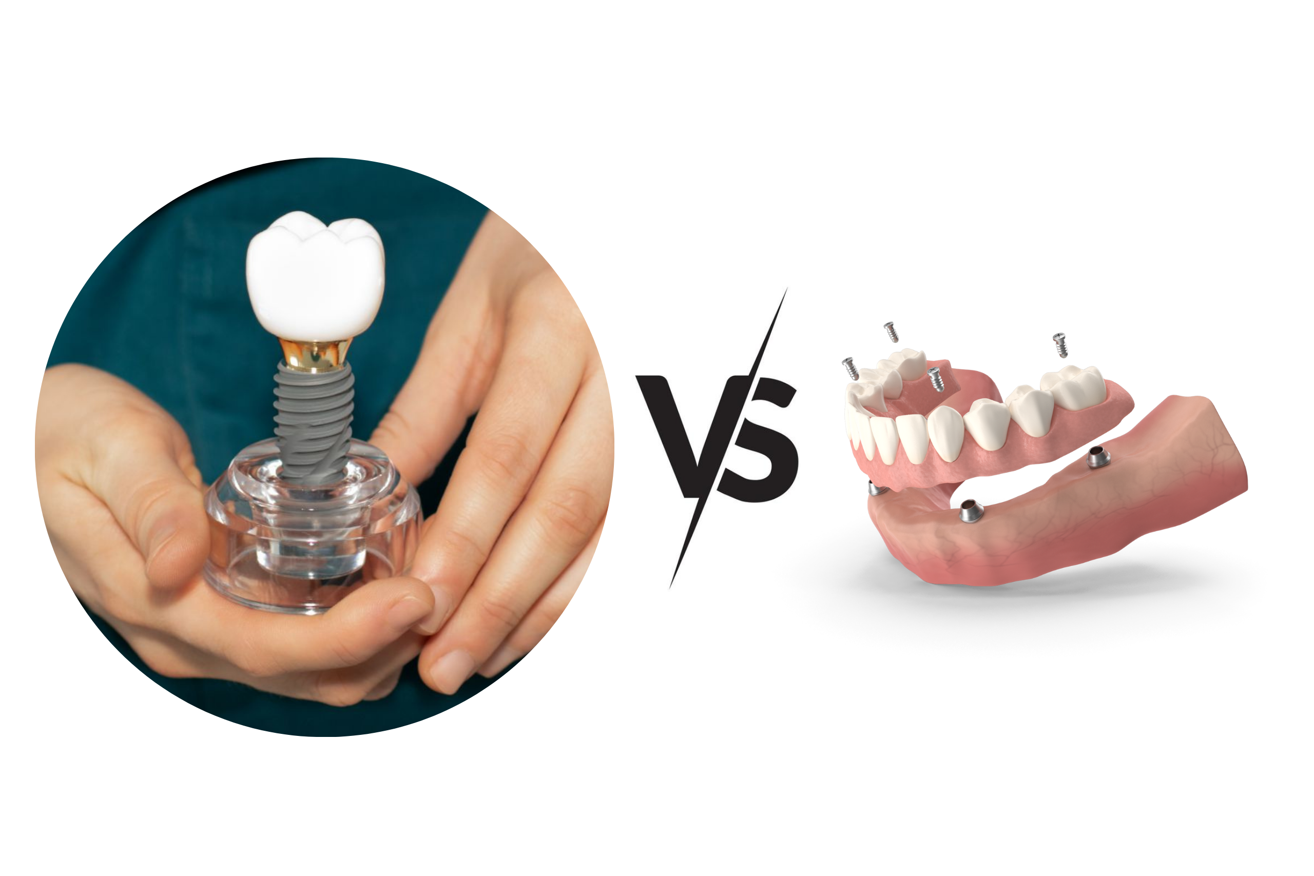 Dental Implants vs. Dentures
