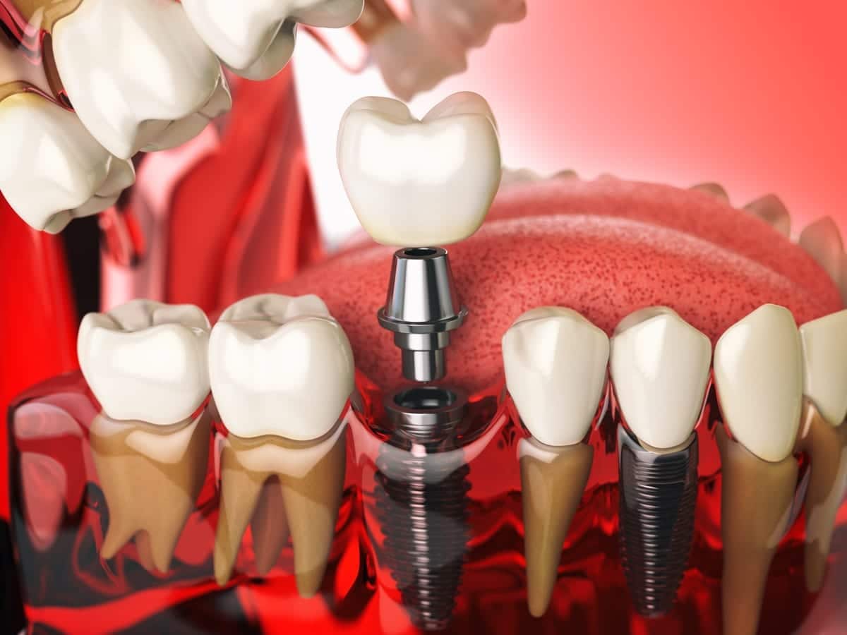 Dental Implants in Gotha