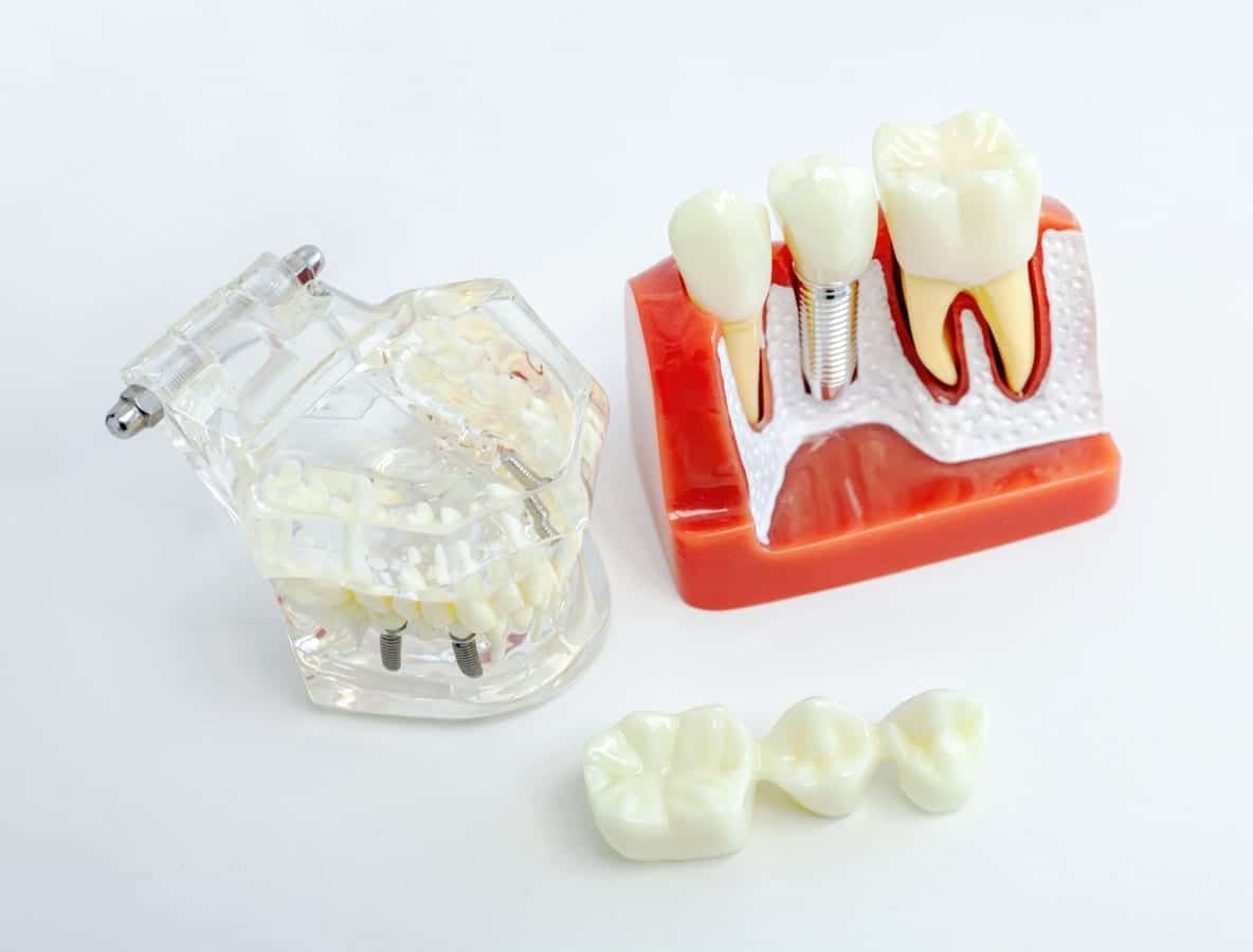 Dental Implants in Oak Ridge